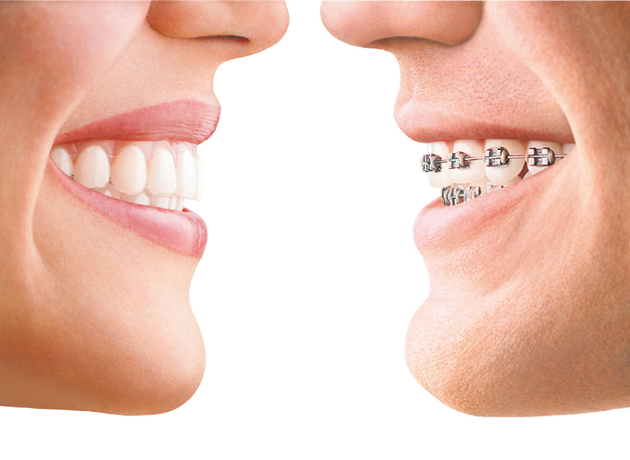 Ortodoncia invisible vs. Brackets