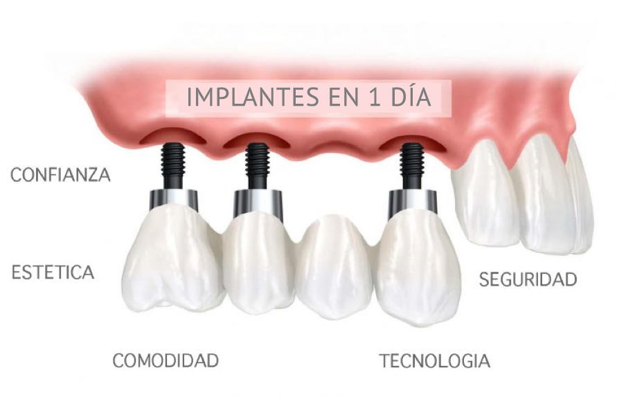 IMPLANTES EN UN SOLO DÍA CLINICA DENTAL MONFORTE