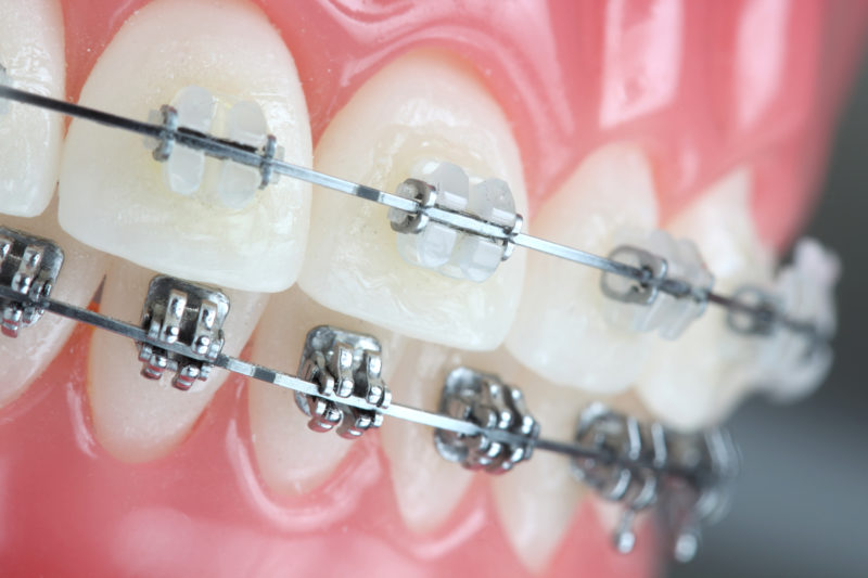 ortodoncia invisible vs brackets