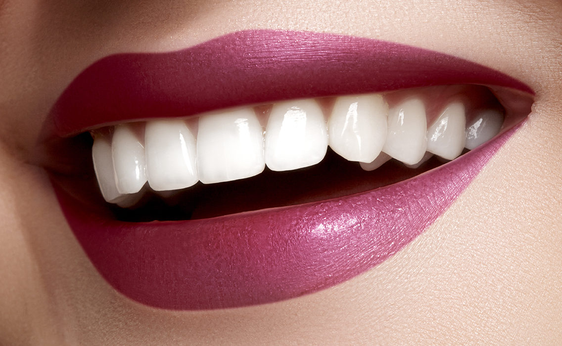 Blanqueamiento dientes mas blancos clinica dental monforte