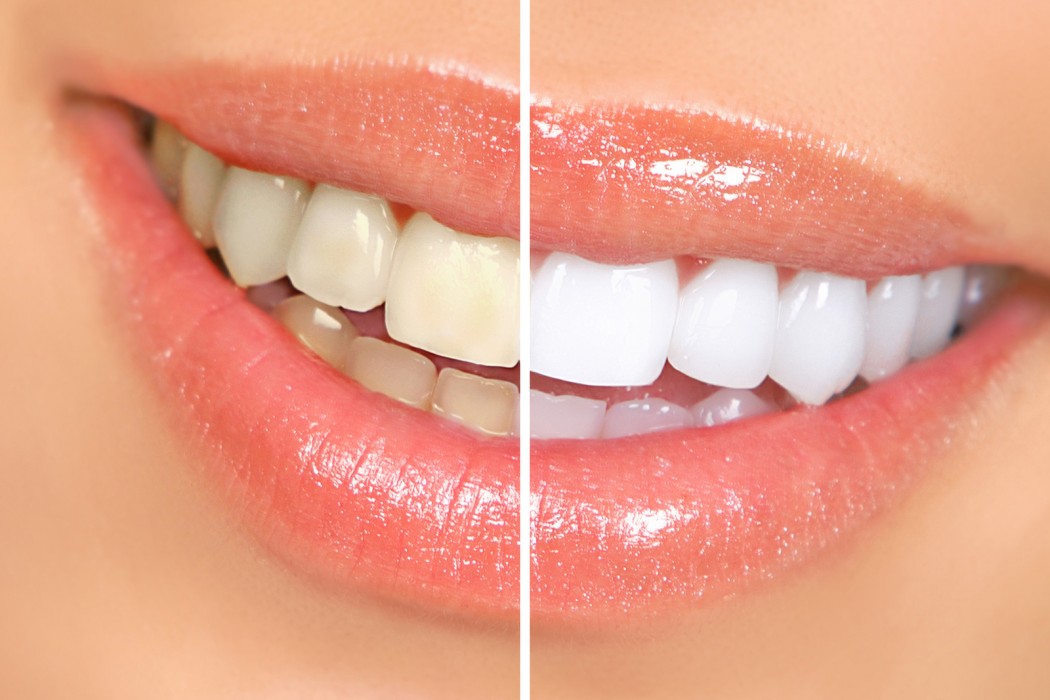 Blanqueamiento dientes mas blancos clinica dental monforte