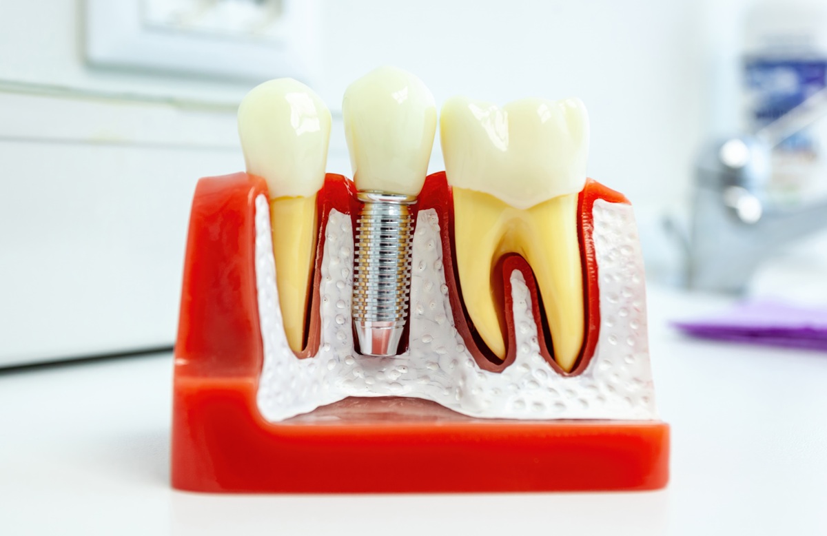 Implante dental osteointegrado