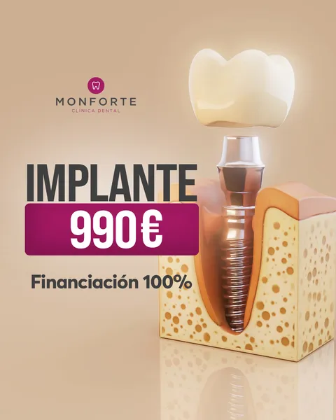 Implante dental 990 € con financiación al 100 %